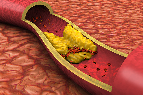 Image representing YOUR CHOLESTEROL